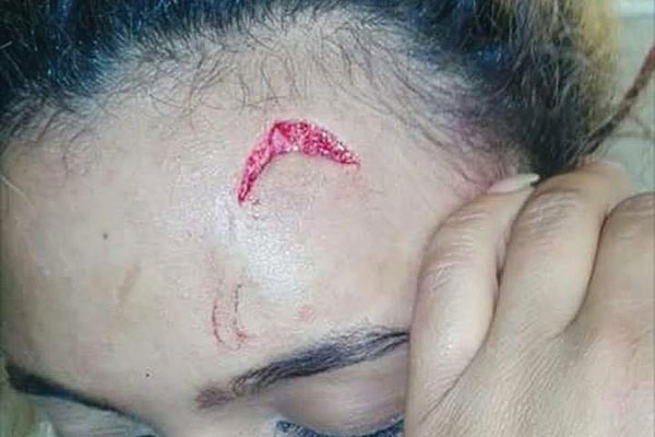 Gabriella Engels shows the deep cut she sustained after Grace allegedly attacked her