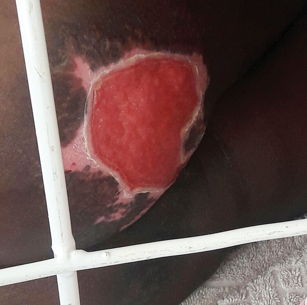 A picture showing wounds on her backside that were caused by the suspected caustic soda she had been made to sit on by the police