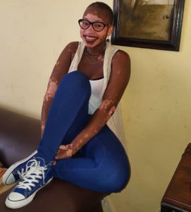 There is more to me than vitiligo There is more to me than vitiligo
