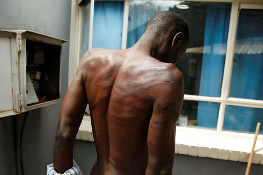 A man who was injured during violent protests is seen at a hospital in Harare, Zimbabwe, Jan. 16, 2019. The Zimbabwe bishops' justice and peace commission is collecting information on violence and human rights abuses in dioceses across the country.