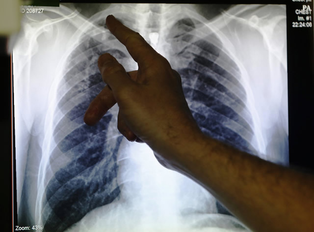‘Invest more in TB fight’
